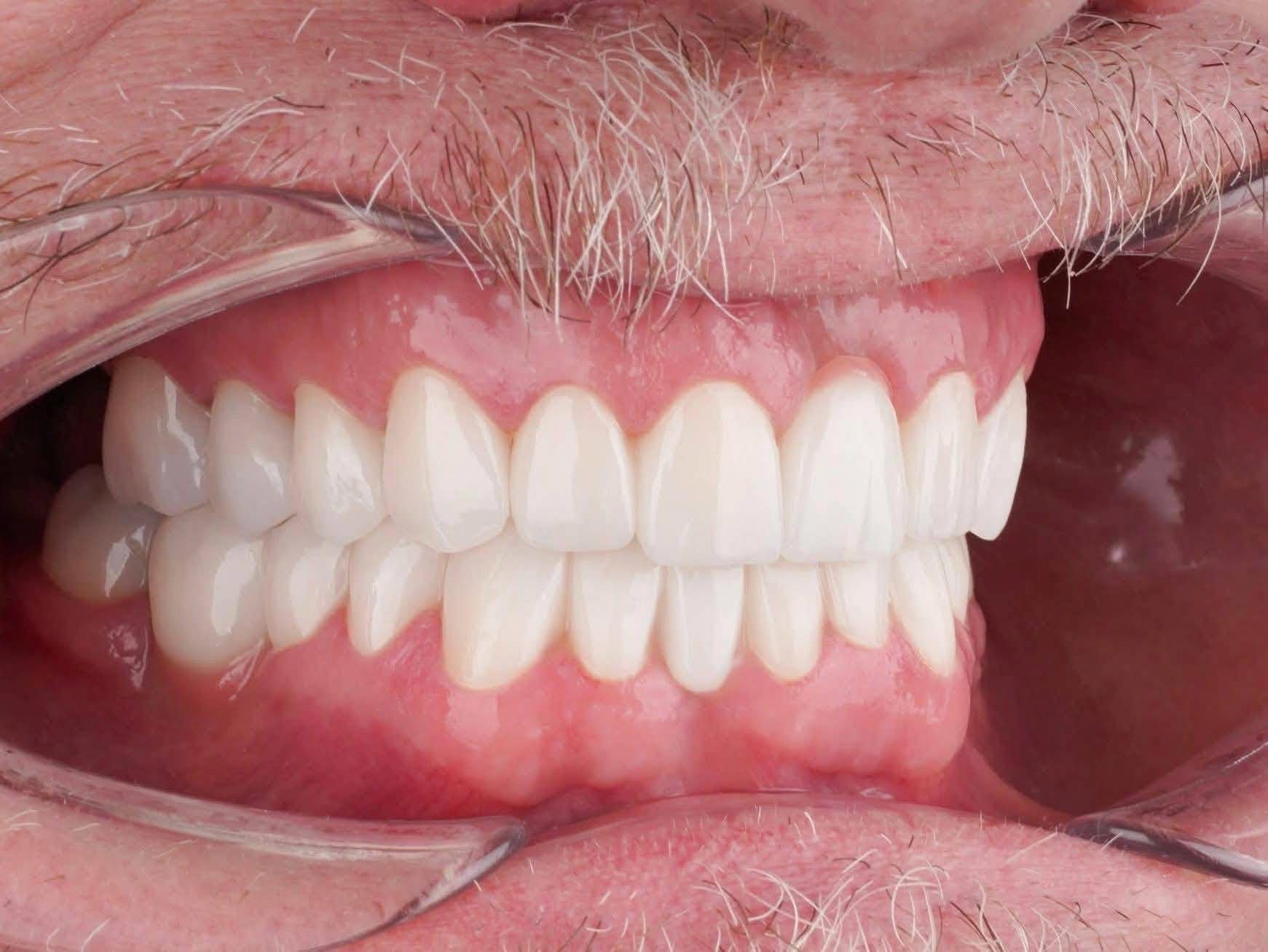 Patient after full mouth dental implants in Turkey