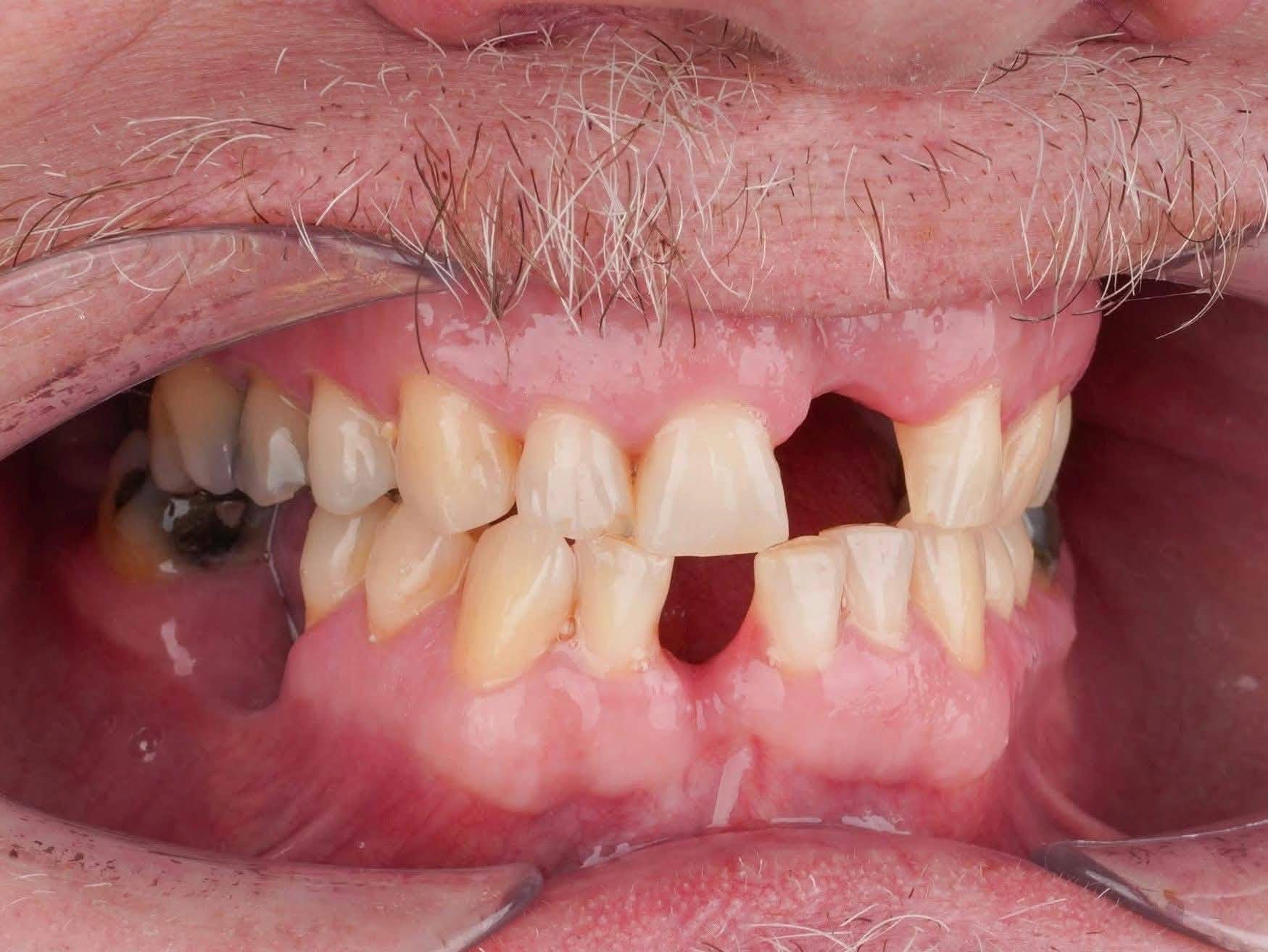 Patient before full mouth dental implants in Turkey