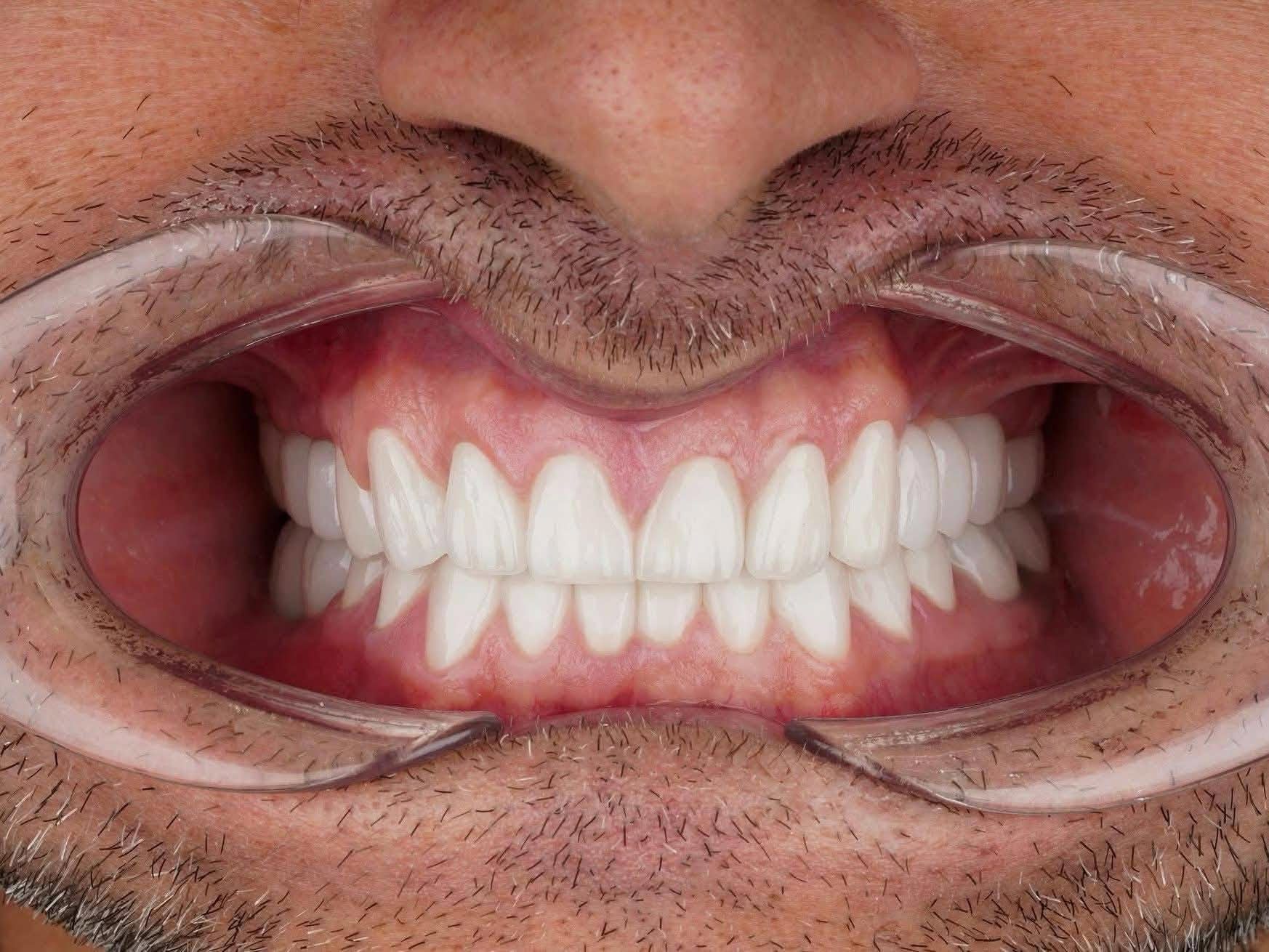 Patient front-tooth photograph after porcelain veneers in Turkey