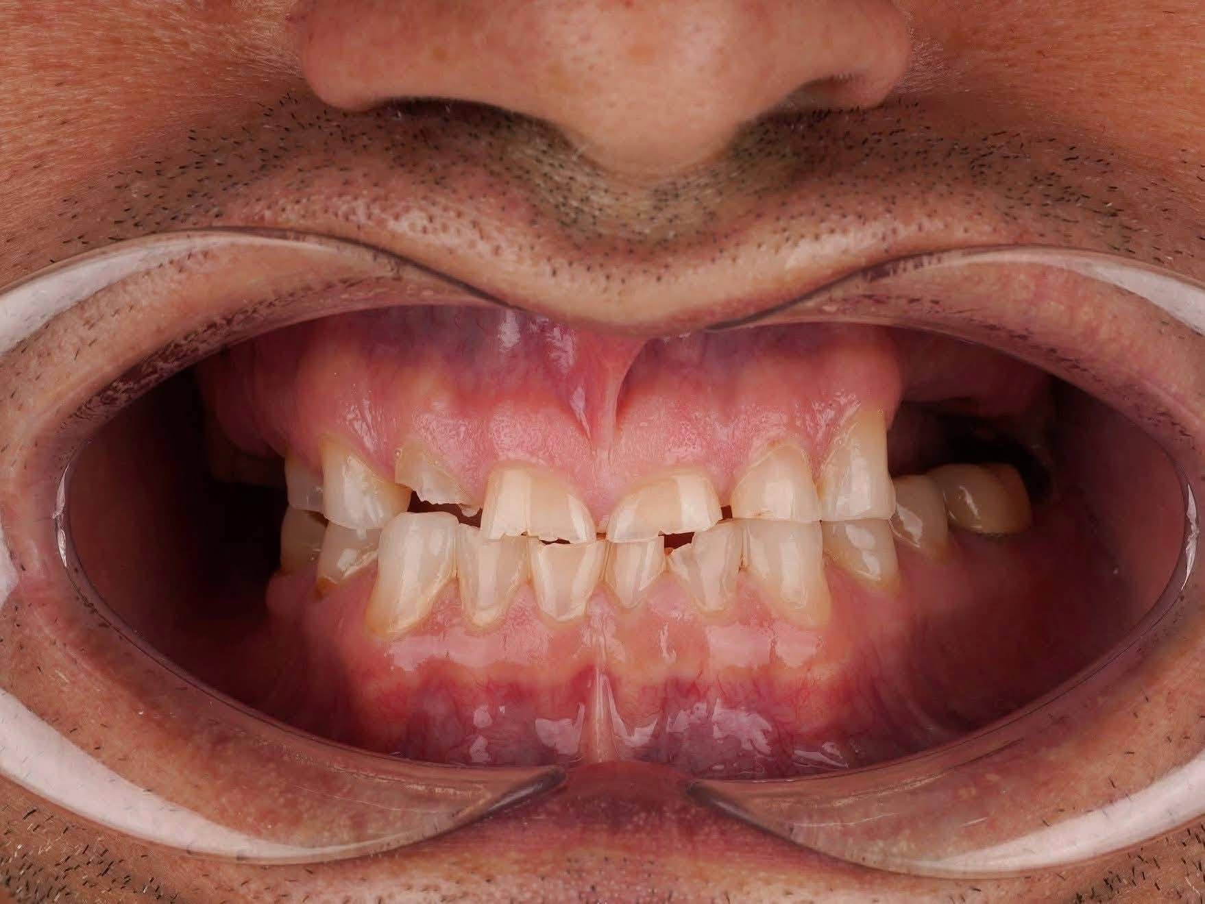 Patient front-tooth photograph before porcelain veneers in Turkey
