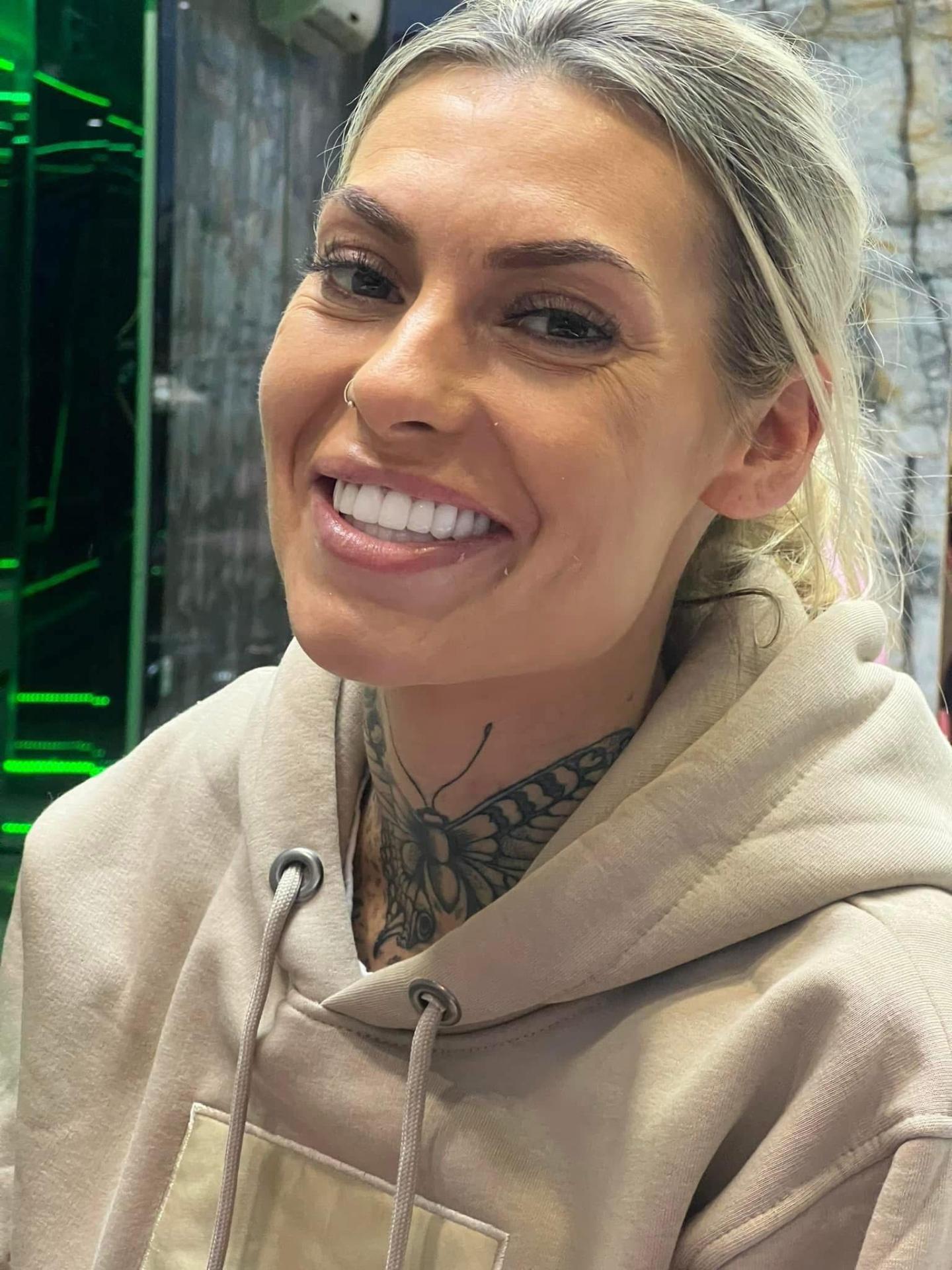Hollywood Smile patient from Swansea