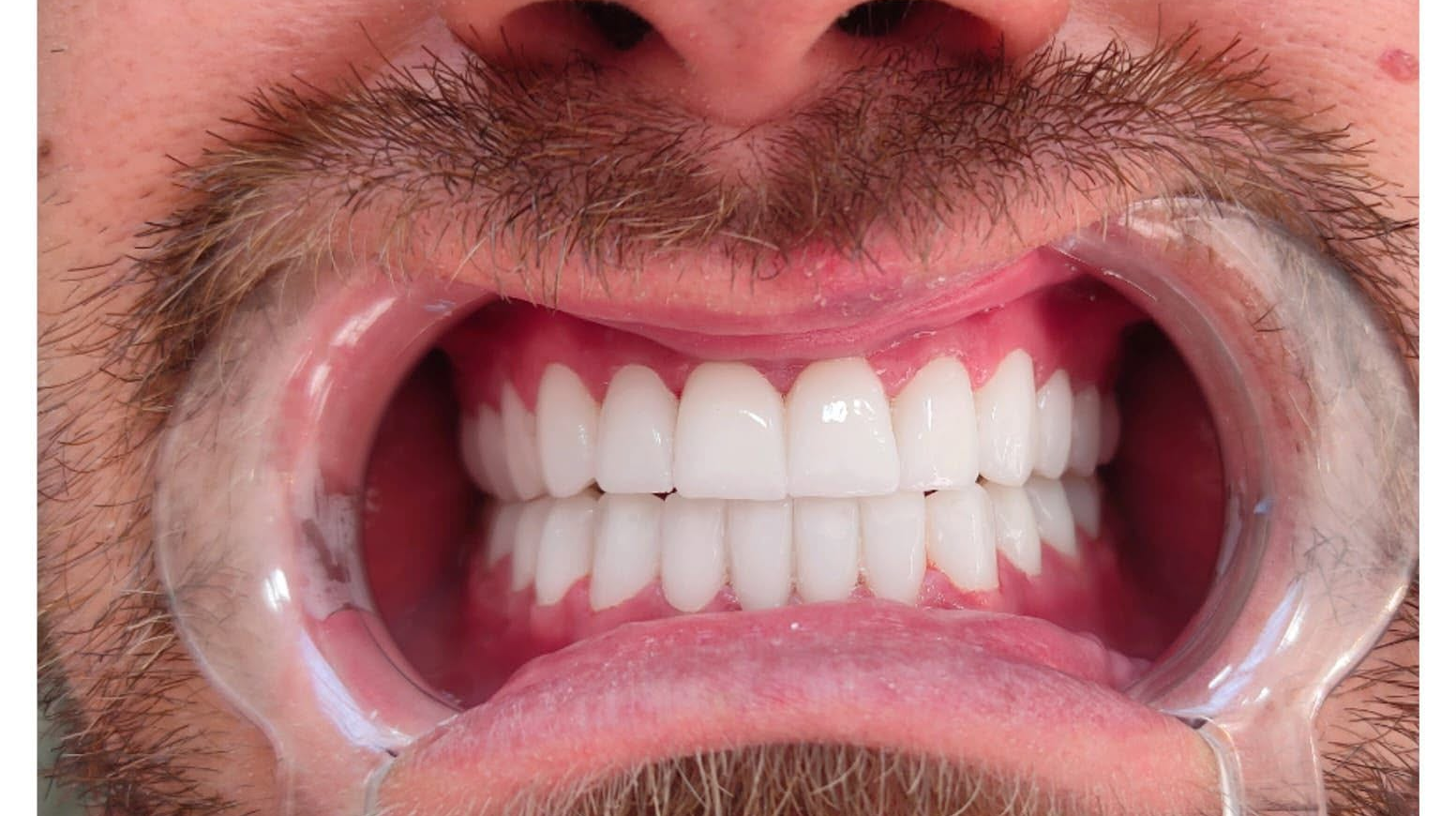 Full upper and lower veneers, after
